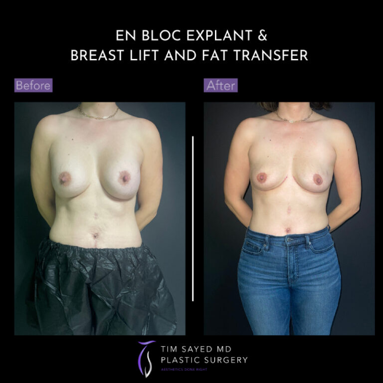 before and after en bloc explant with fat grafting front view of patient 8885