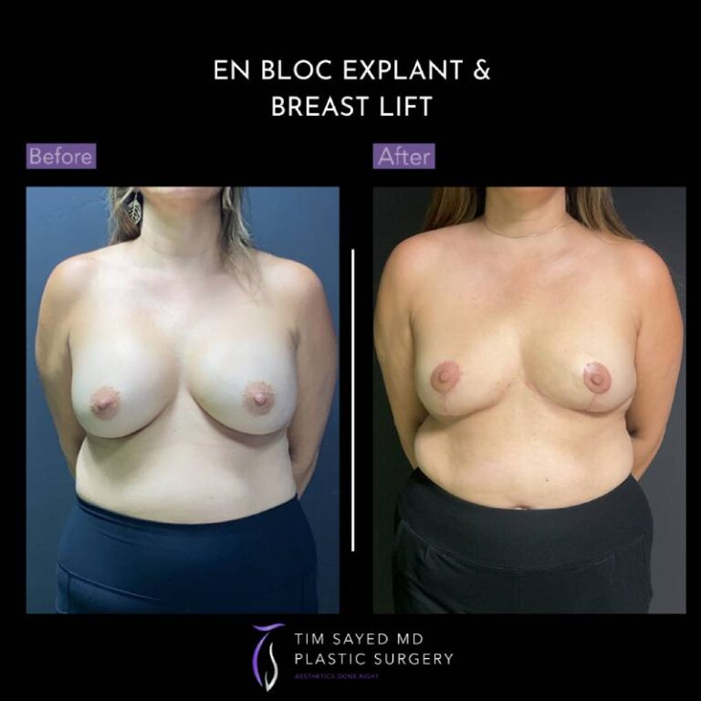 before and after en bloc explant with mastopexy front view of patient 8757