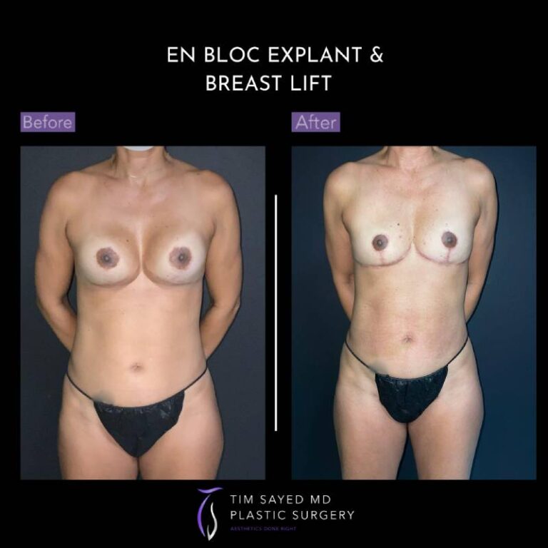 before and after en bloc explant with mastopexy front view of patient 8760