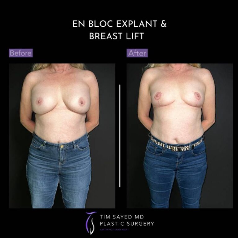 before and after en bloc explant with mastopexy front view of patient 8763
