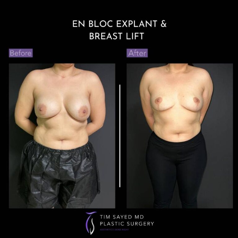 before and after en bloc explant with mastopexy front view of patient 8767