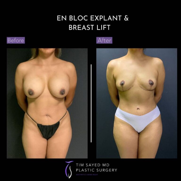before and after en bloc explant with mastopexy front view of patient 8770