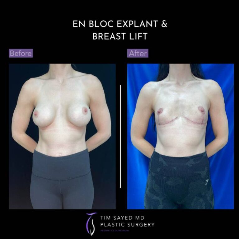 before and after en bloc explant with mastopexy front view of patient 8773