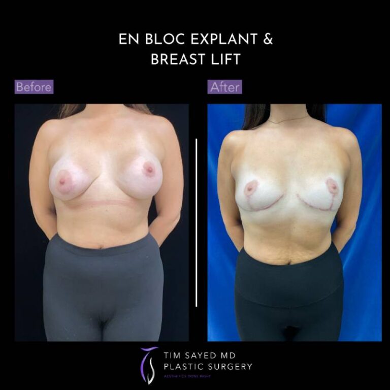 before and after en bloc explant with mastopexy front view of patient 8779