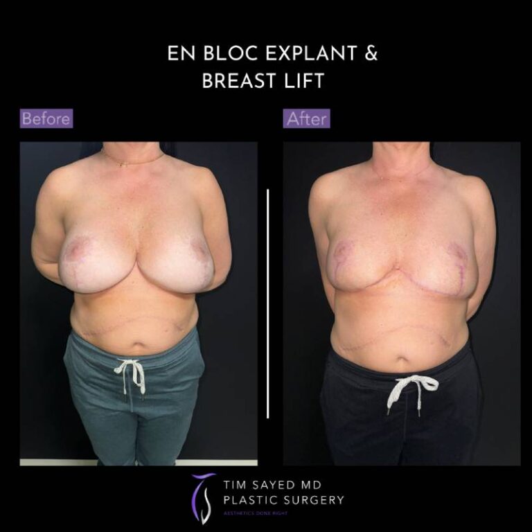 before and after en bloc explant with mastopexy front view of patient 8782