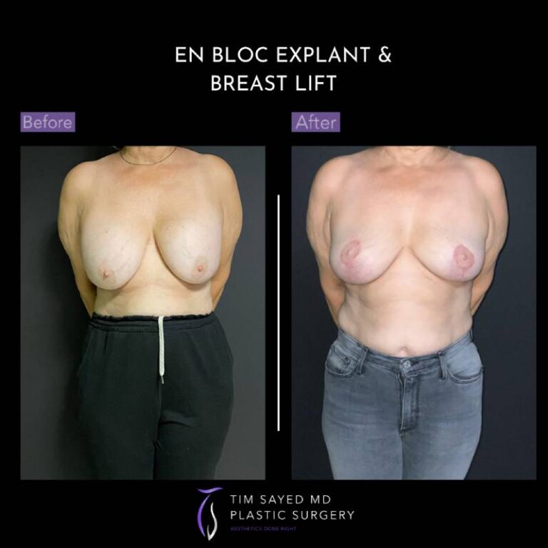 before and after en bloc explant with mastopexy front view of patient 8785