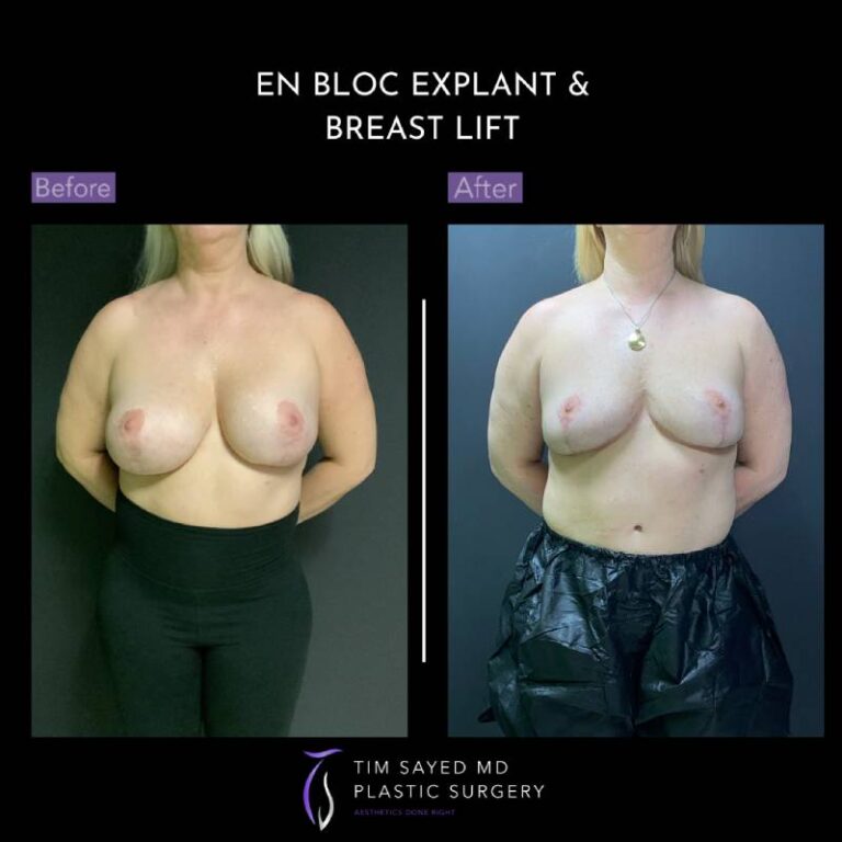 before and after en bloc explant with mastopexy front view of patient 8788