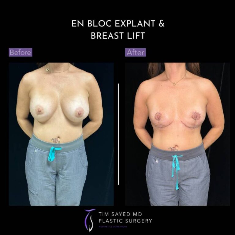 before and after en bloc explant with mastopexy front view of patient 8794