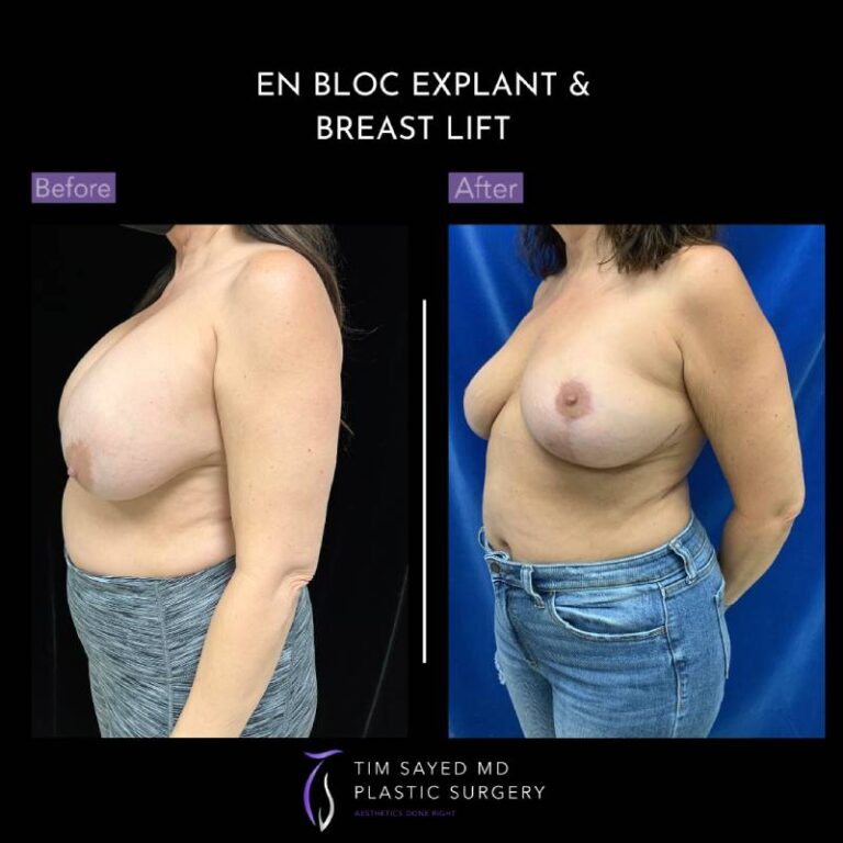 before and after en bloc explant with mastopexy left angle view of patient 8797