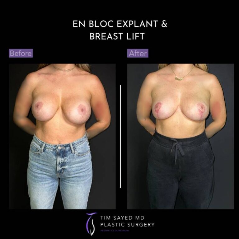 before and after en bloc explant with mastopexy front view of patient 8799