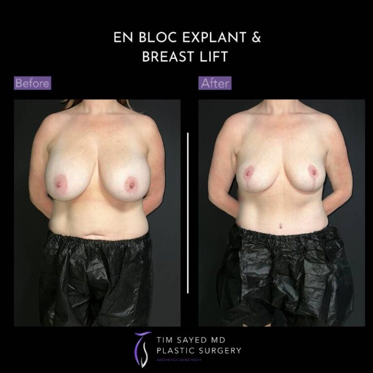 before and after en bloc explant with mastopexy front view of patient 8811