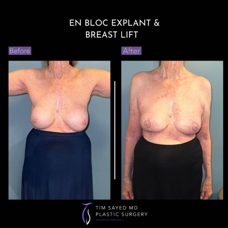 before and after en bloc explant with mastopexy front view of patient 8815