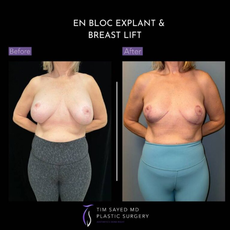 before and after en bloc explant with mastopexy front view of patient 8818