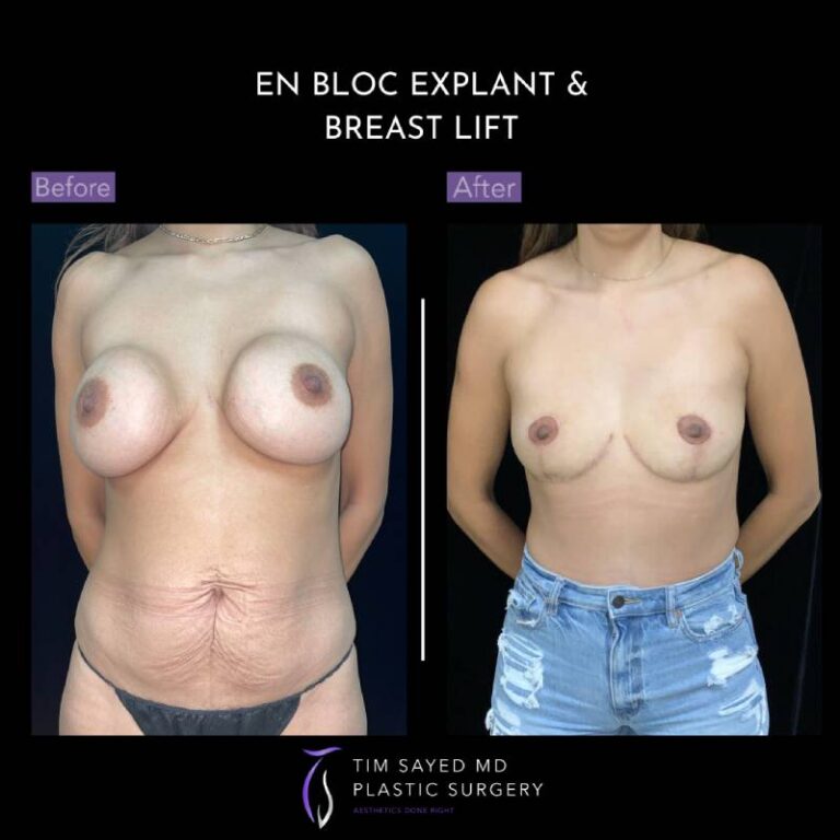 before and after en bloc explant with mastopexy front view of patient 8824