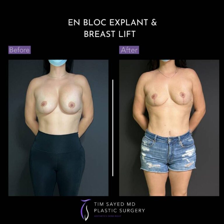 before and after en bloc explant with mastopexy front view of patient 8831