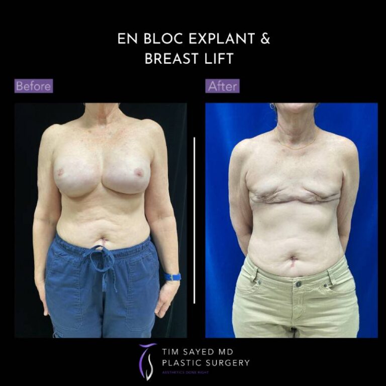 before and after en bloc explant with mastopexy front view of patient 8834