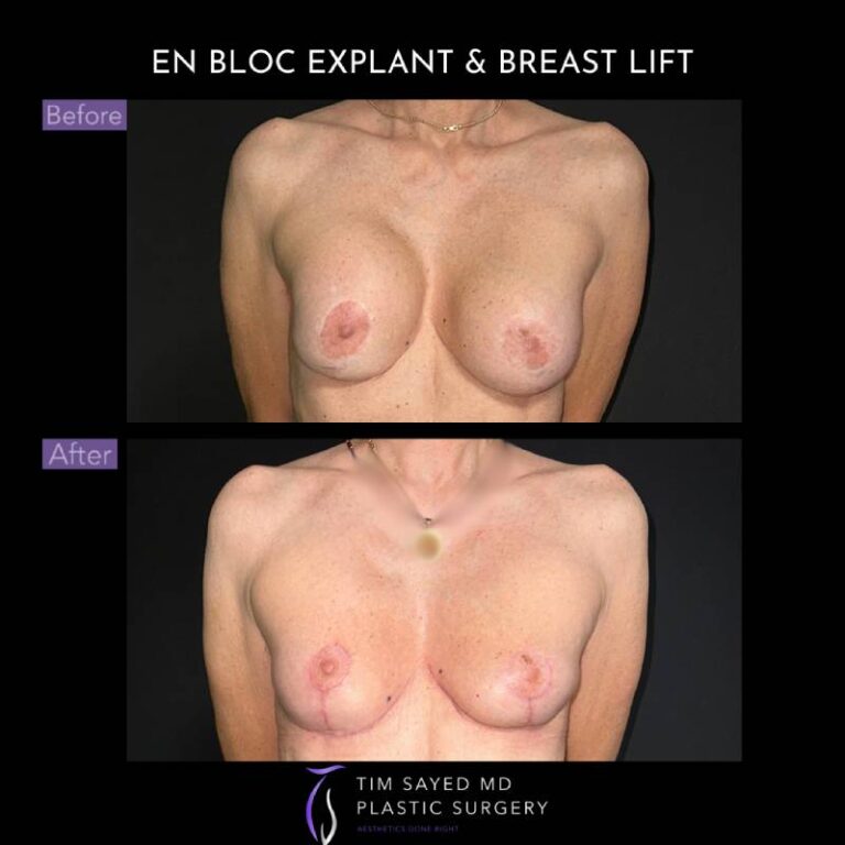 before and after en bloc explant with mastopexy front view of patient 8836