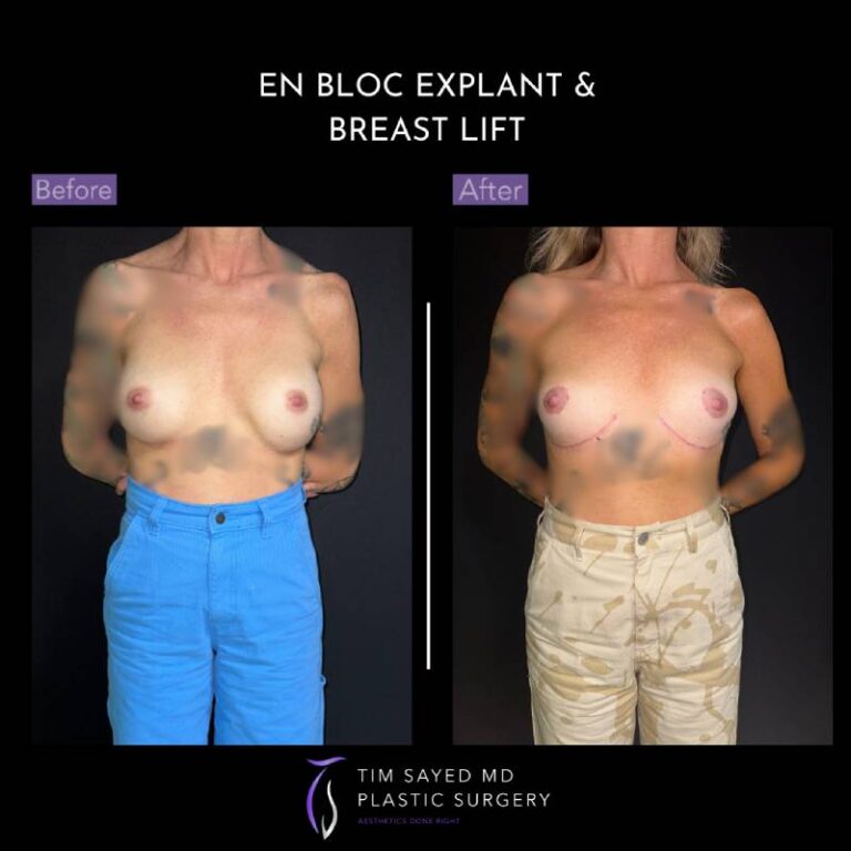 before and after en bloc explant with mastopexy front view of patient 8839