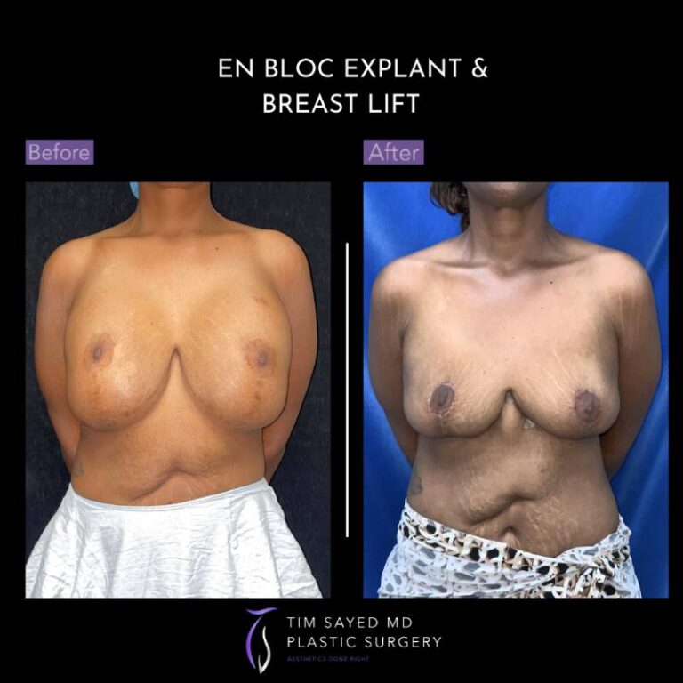before and after en bloc explant with mastopexy front view of patient 8842