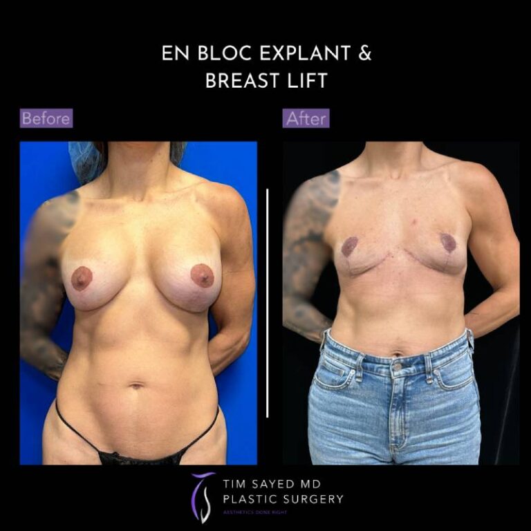 before and after en bloc explant with mastopexy front view of patient 8845