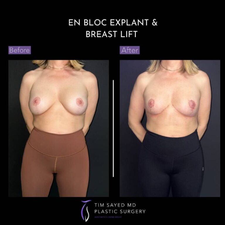 before and after en bloc explant with mastopexy front view of patient 8848