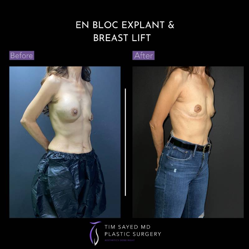 before and after en bloc explant with mastopexy right angle view of patient 8851
