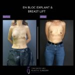 before and after en bloc explant with mastopexy front view of patient 8851