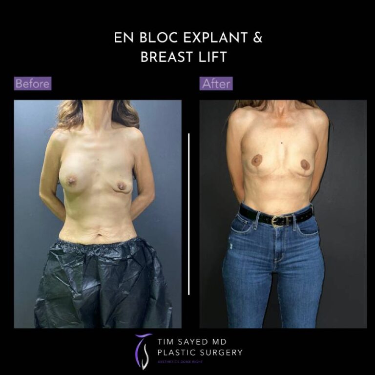 before and after en bloc explant with mastopexy front view of patient 8851