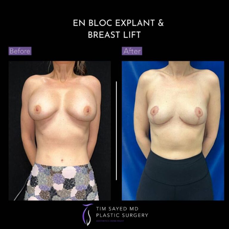 before and after en bloc explant with mastopexy front view of patient 8854