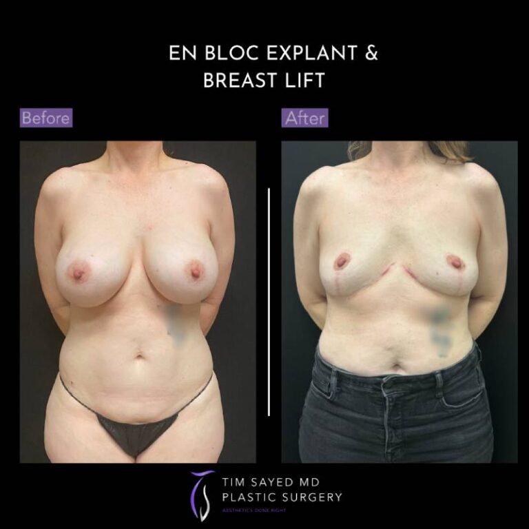 before and after en bloc explant with mastopexy front view of patient 8858