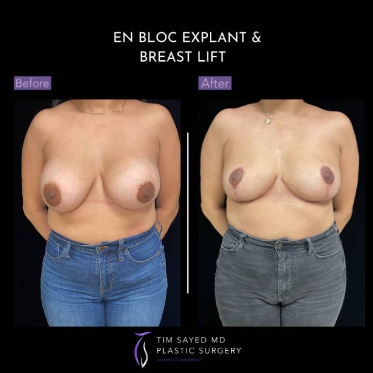 before and after en bloc explant with mastopexy front view of patient 8867