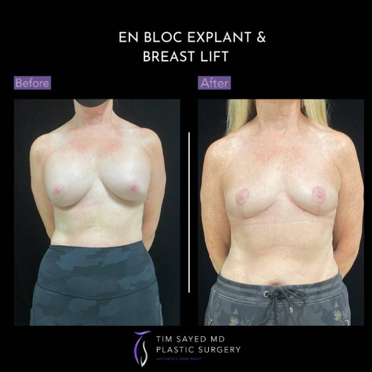 before and after en bloc explant with mastopexy front view of patient 8881