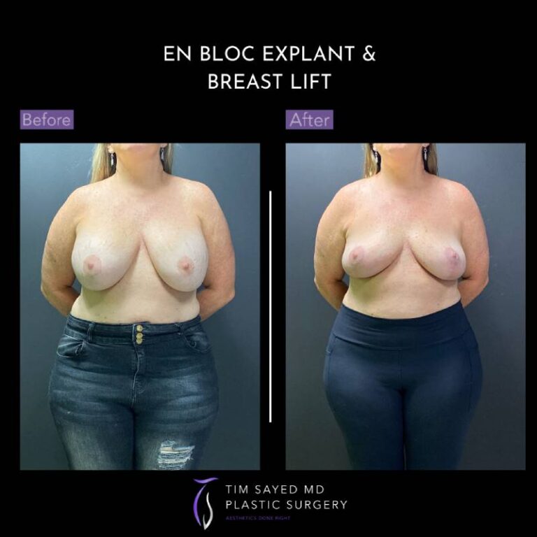 before and after en bloc explant with mastopexy front view of patient 8884