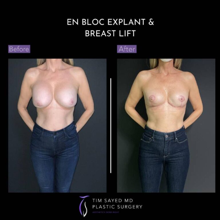 before and after en bloc explant with mastopexy front view of patient 8890