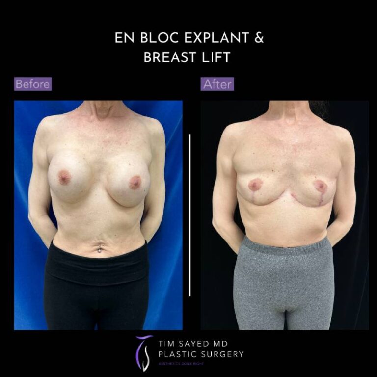 before and after en bloc explant with mastopexy front view of patient 8893