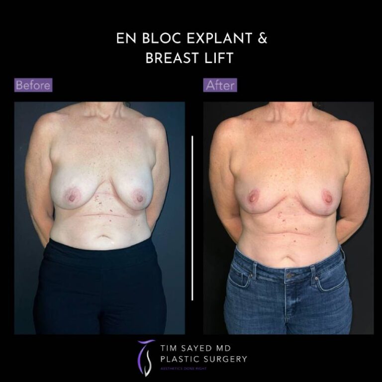 before and after en bloc explant with mastopexy front view of patient 8898