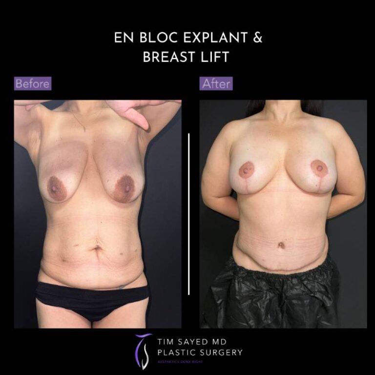 before and after front view en bloc breast implant removal with mastopexy case 8908