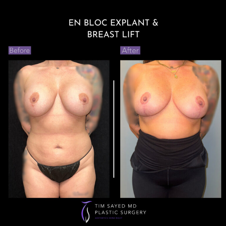 before and after front view en bloc breast implant removal with mastopexy case 8929