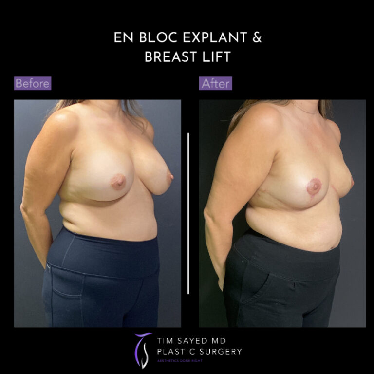 before and after right angle view en bloc breast implant removal with mastopexy case 8924