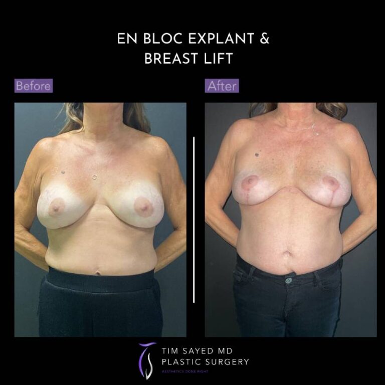 before and after front view en bloc breast implant removal with mastopexy case 8935