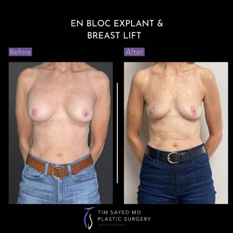 before and after front view en bloc breast implant removal with mastopexy case 8938