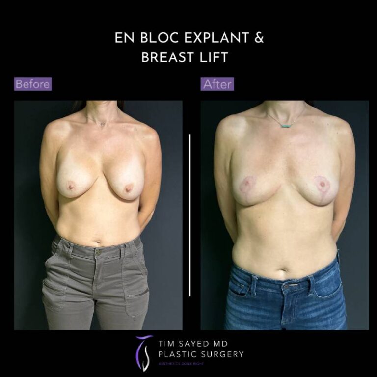 before and after front view en bloc breast implant removal with mastopexy case 8941