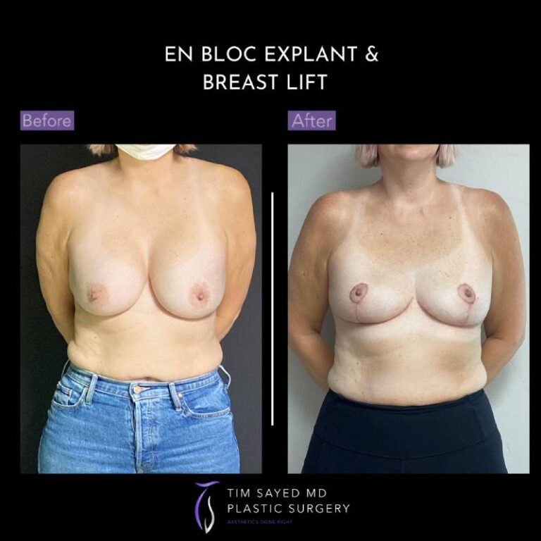 before and after front view en bloc breast implant removal with mastopexy case 8944