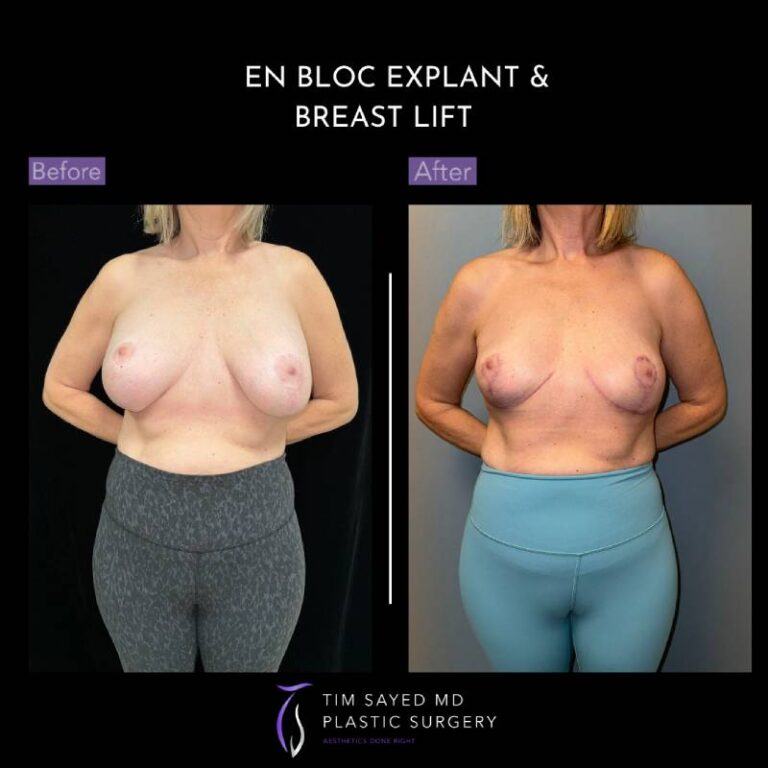 before and after front view en bloc breast implant removal with mastopexy case 8959