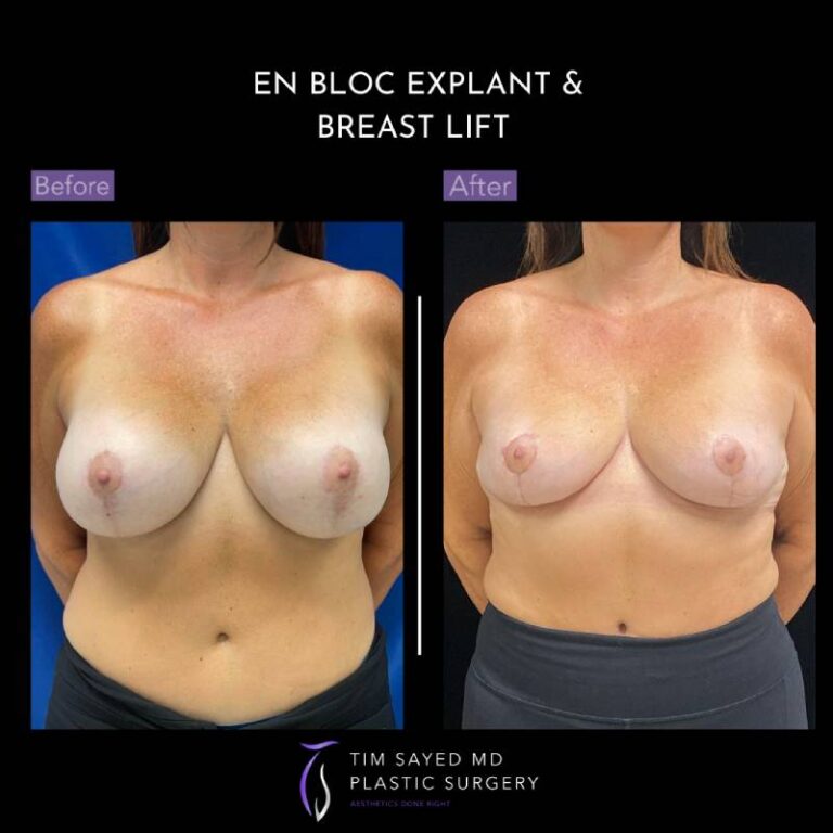 before and after front view en bloc breast implant removal with mastopexy case 8953
