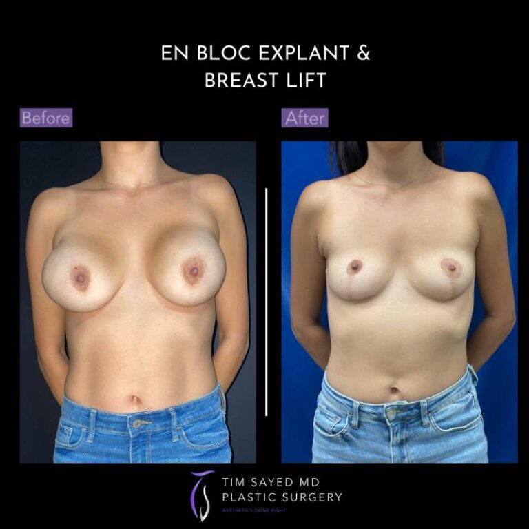 before and after front view en bloc breast implant removal with mastopexy case 8959