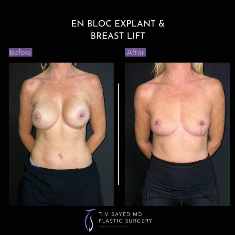 before and after front view en bloc breast implant removal with mastopexy case 8966