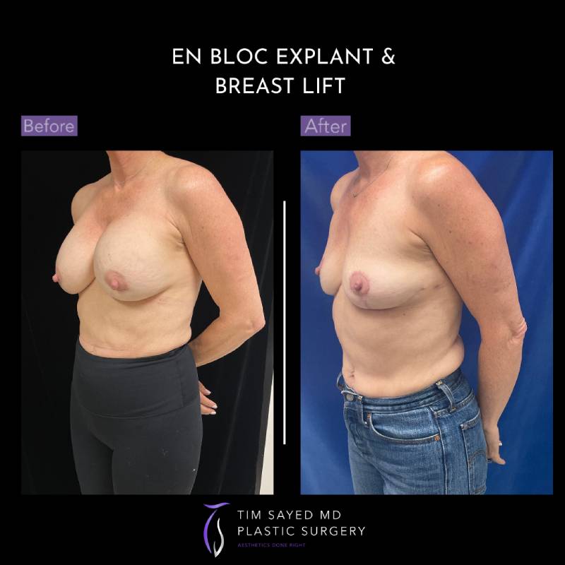 before and after front view en bloc breast implant removal with mastopexy case 8969