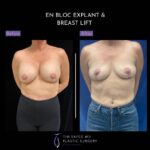 before and after front view en bloc breast implant removal with mastopexy case 8969