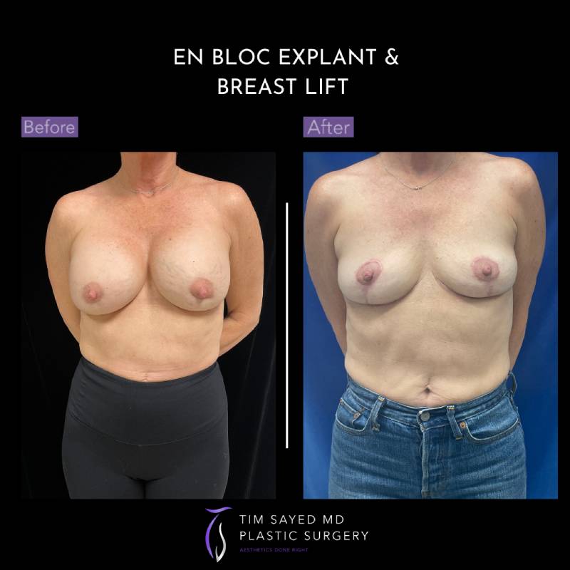 before and after front view en bloc breast implant removal with mastopexy case 8969